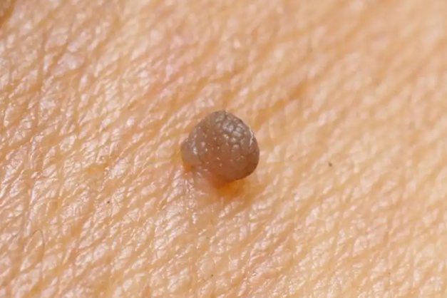 腹股沟皮赘图片