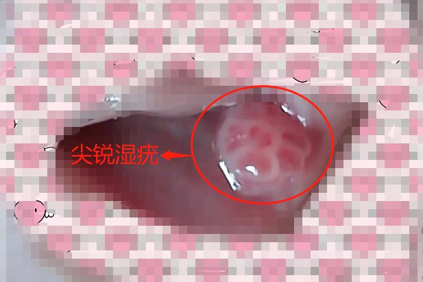 真性尖锐湿疣