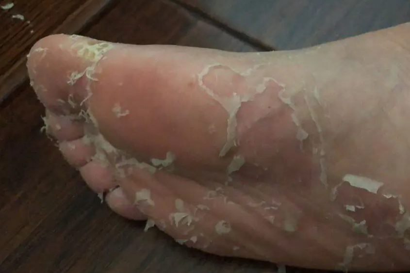 足光散泡脚后的图片