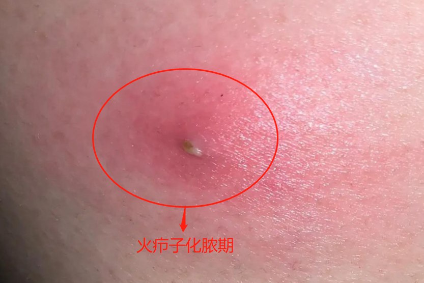 火疖子化脓期