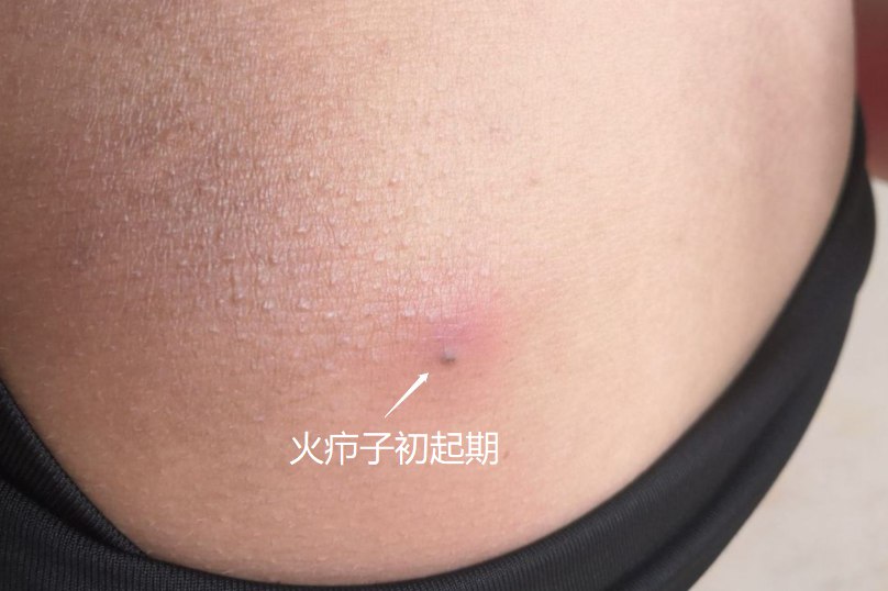 火疖子初起期