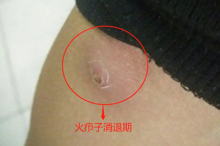 火疖子消退期