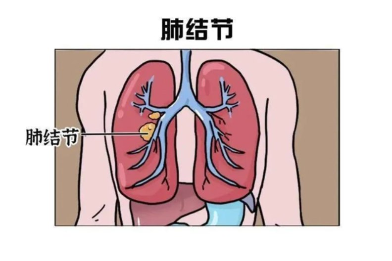 结节病图片