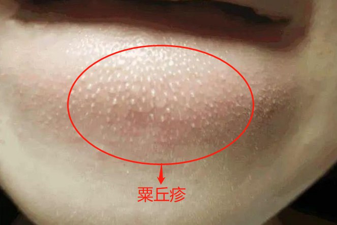 闭合性粉刺图片