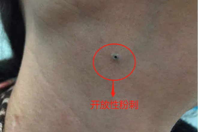 开放性粉刺图片