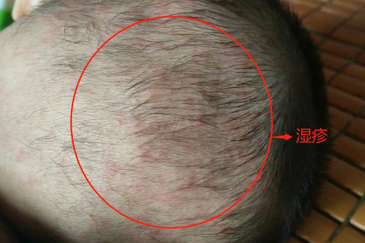 后脑勺湿疹图片