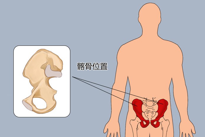 髂骨位置示意图