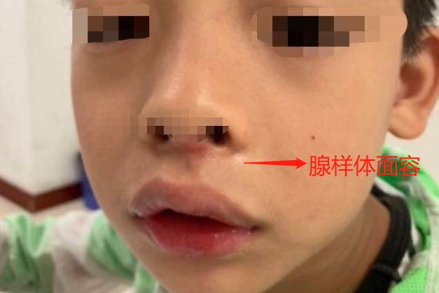 腺样体面容图片