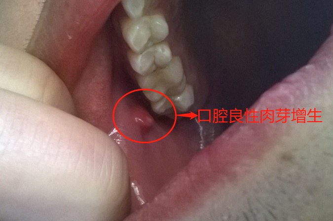 口腔良性肉芽增生