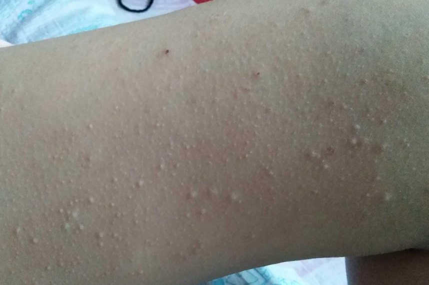 过敏性荨麻疹