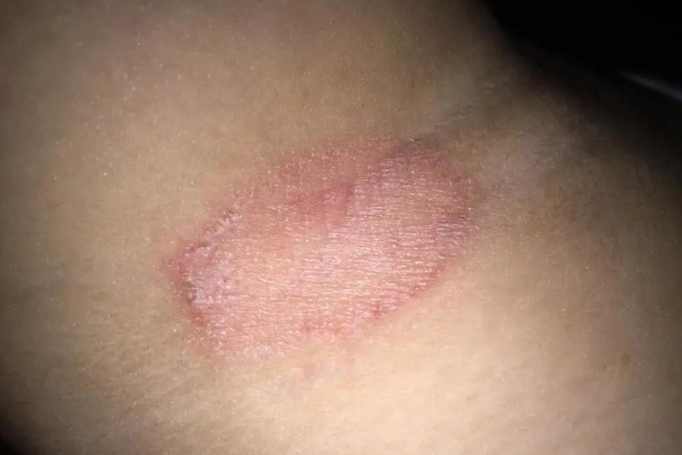 腋下红癣