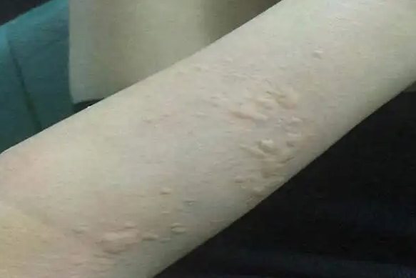 荨麻疹
