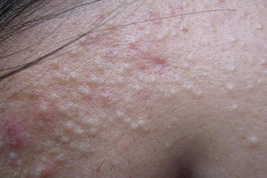 酒刺是什么样的图片