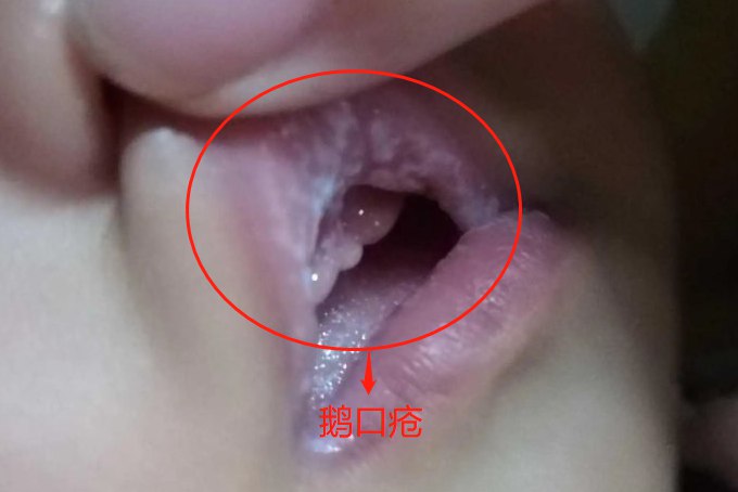 鹅口疮