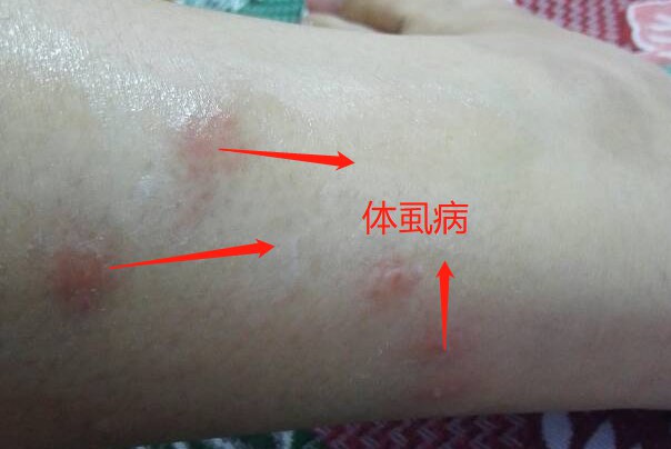 体虱叮咬后图片