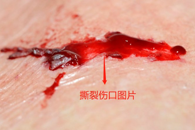 撕裂伤口图片