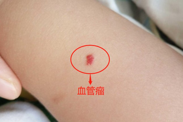 胳膊血管瘤