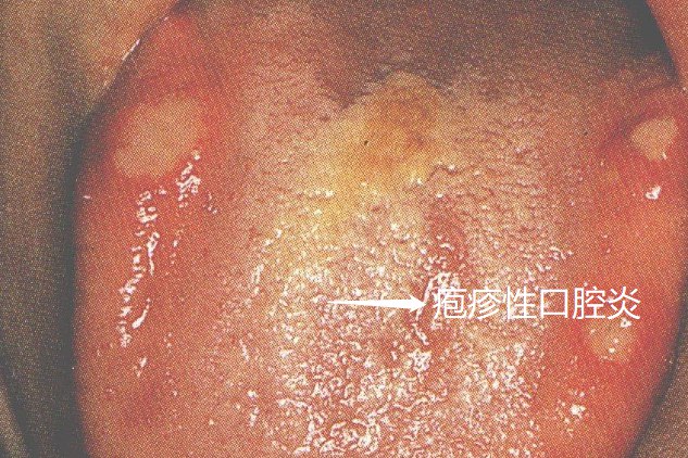 疱疹性口腔炎
