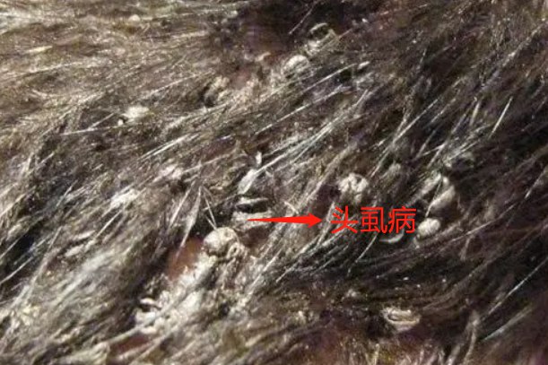 头虱叮咬后图片