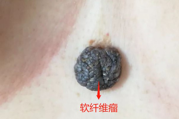 小儿软纤维瘤