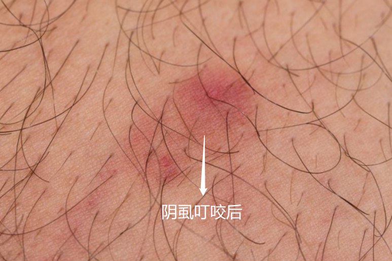阴虱叮咬后图片