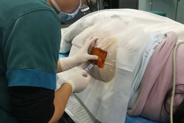 引流术后填充纱布的图片_图文_文章_美咯_让您放心美!