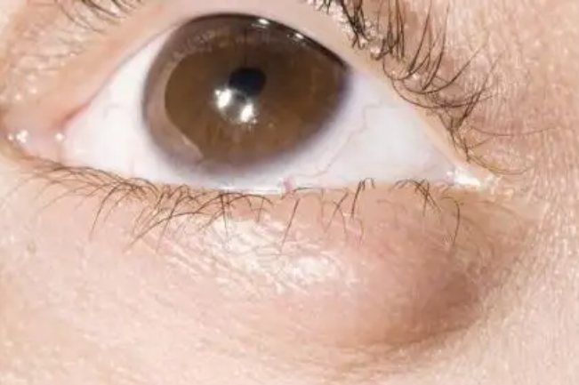 睑板腺囊肿早期主要表现为眼睑上出现与皮肤无粘连的肿块,后肿块逐渐