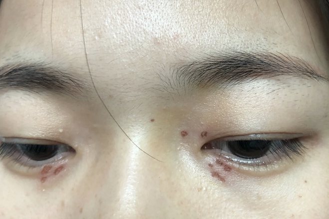 眼部脂肪粒激光后图片