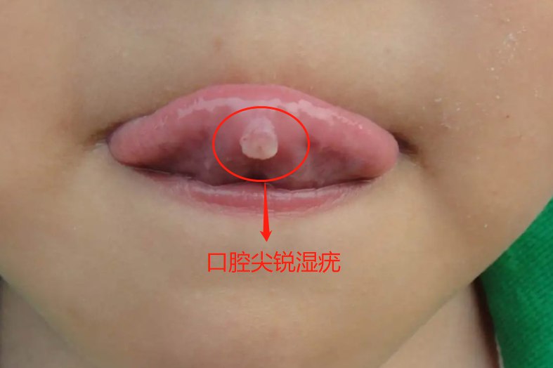 hpv口腔感染表现图图片