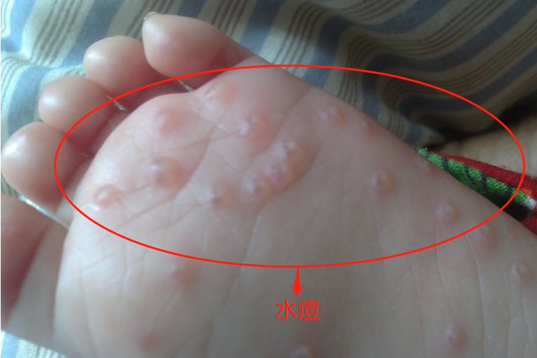 此外,水痘的病情进展过程中,特征性的表现有同时存在斑疹,丘疹,疱疹与