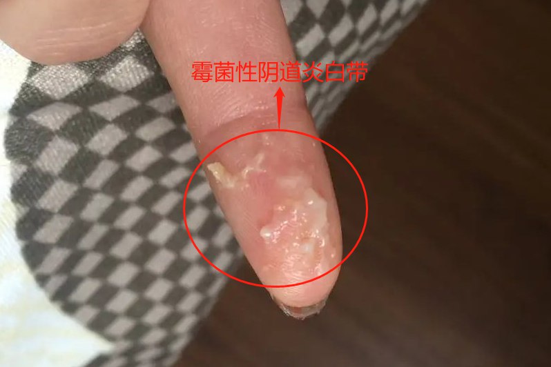 霉菌性阴道炎早期白带
