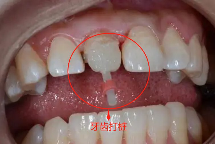 牙齿打桩过程图