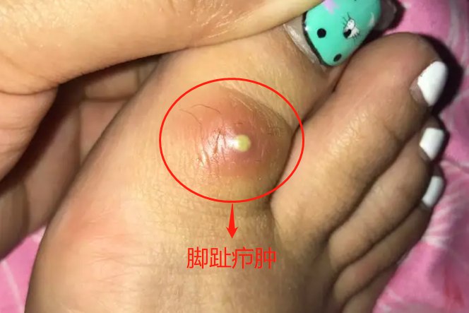 脚趾疖肿图片