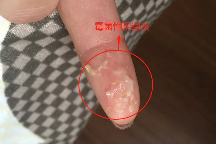 不同炎症的白带的图片