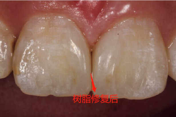 树脂修复后门牙缝图片