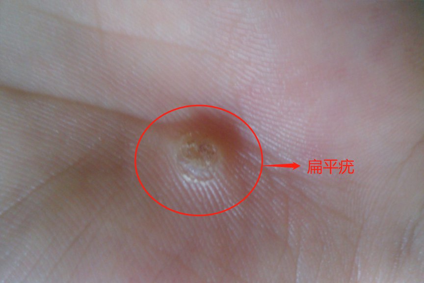 鸡眼和扁平疣的区别图