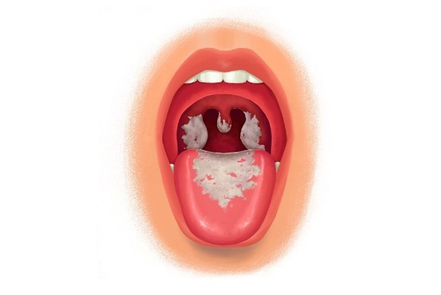 患白喉以后,最常见的症状为咽喉肿痛,不适,颈部淋巴结肿大和低热