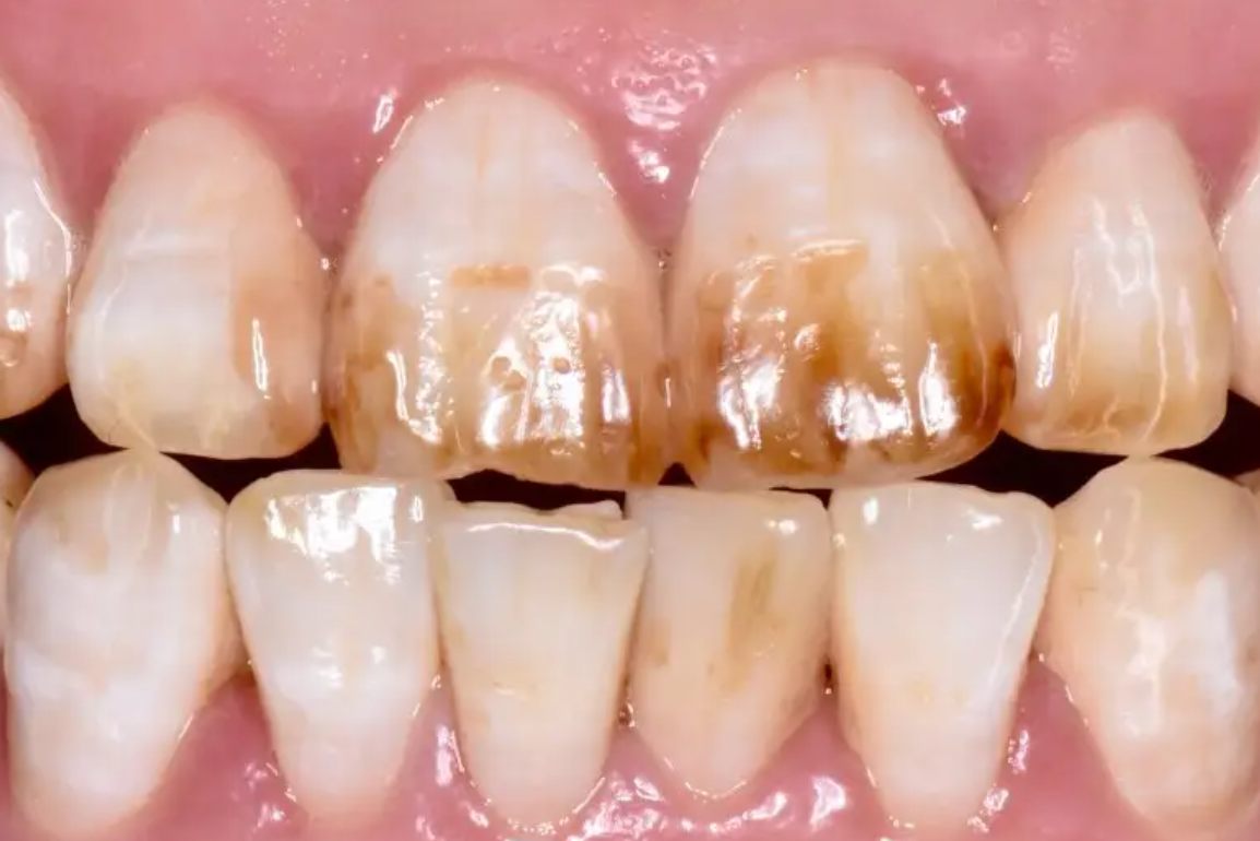 牙齿的各种症状图片图片