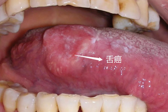 舌头上溃疡怎么治舌癌图片