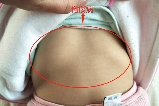 佝偻病胸口骨头突起