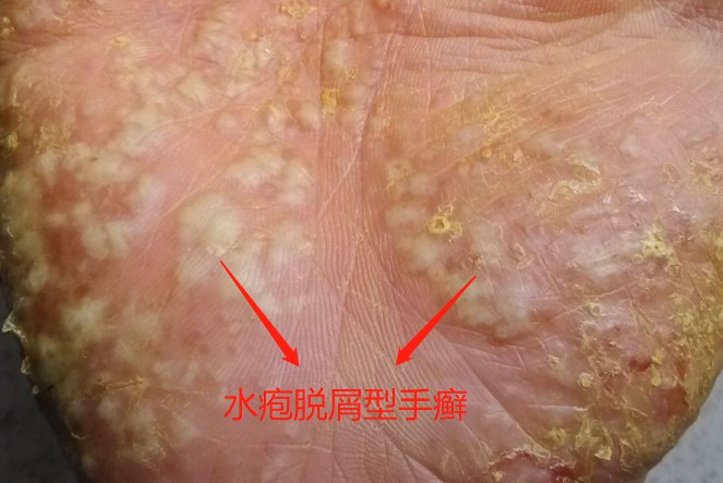 水疱脱屑型手癣
