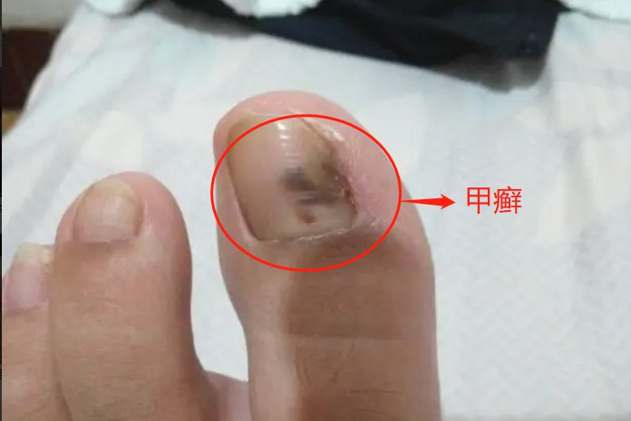 手指甲发黑图片