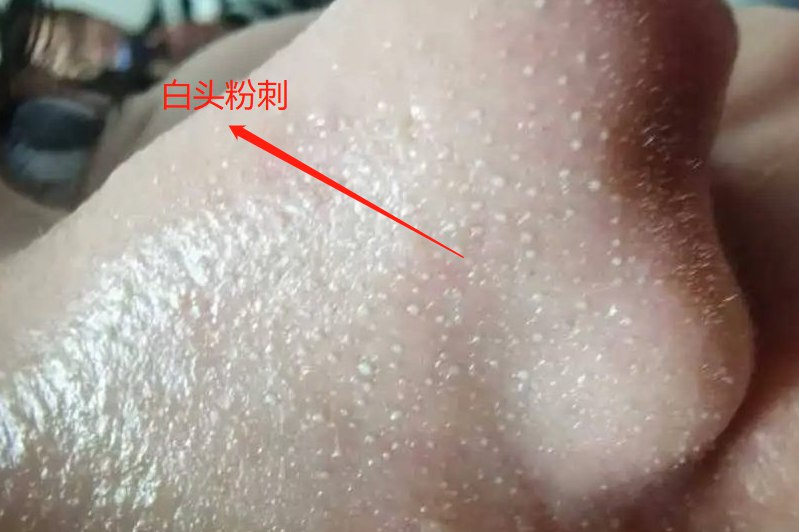 鼻梁上白头粉刺