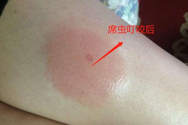席虫咬后图片