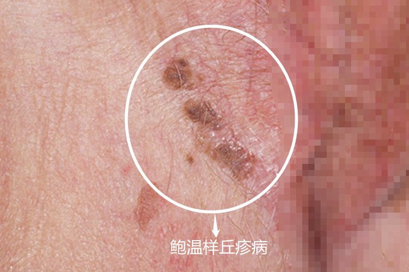 女性鲍温样丘疹病初期图片