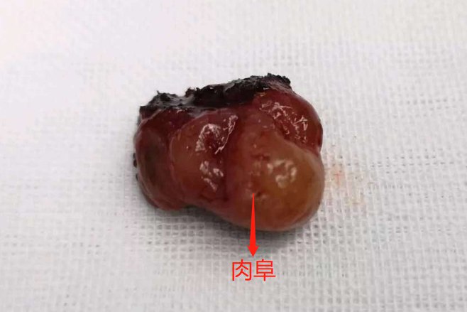 剖腹产刀疤长息肉图片图片