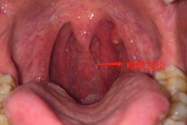 喉咙正常与发炎图片