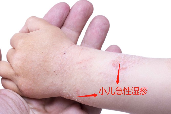 小儿急性湿疹图片