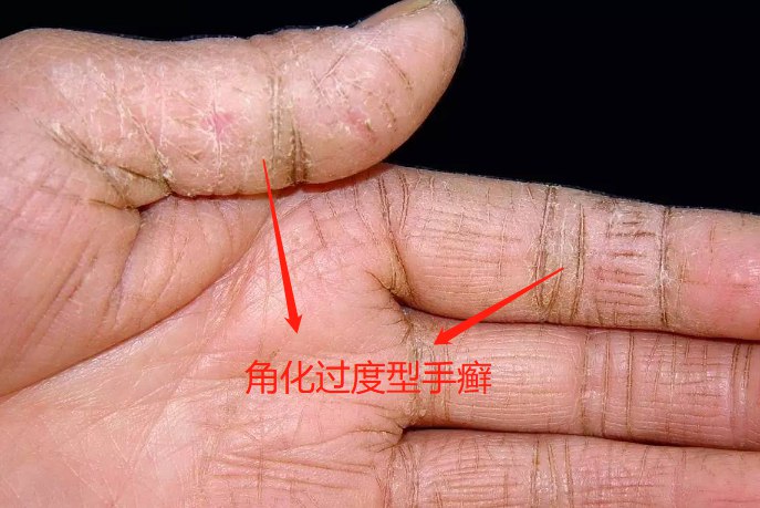 角化过度型手癣