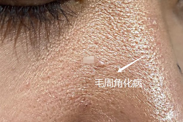 鼻梁上毛周角化病